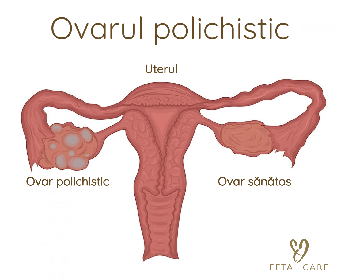 sindromul ovarian polichistic nu poate pierde în greutate